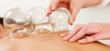 Cupping